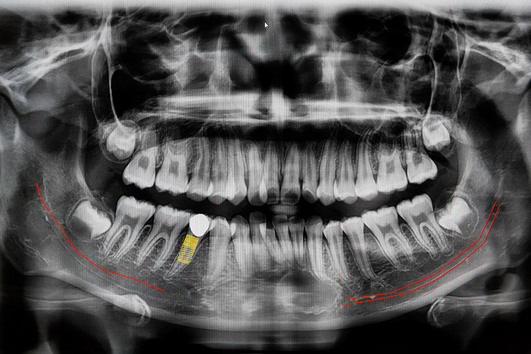 implant img2