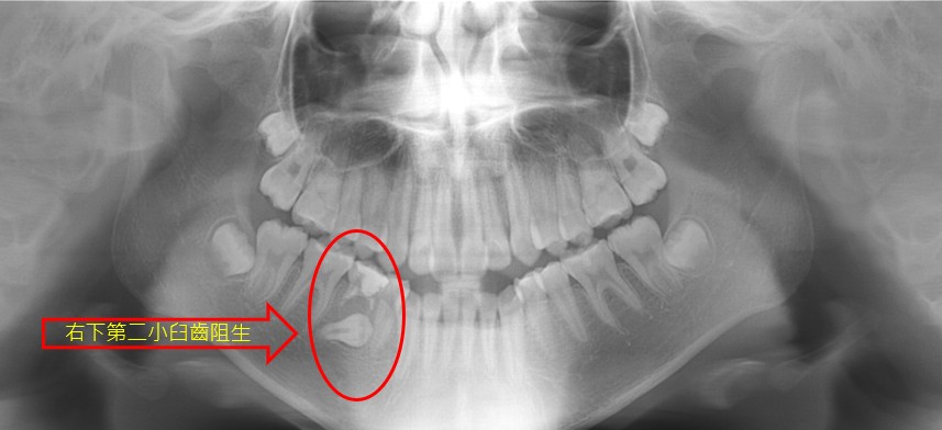 隱形矯正遇到阻生埋伏齒