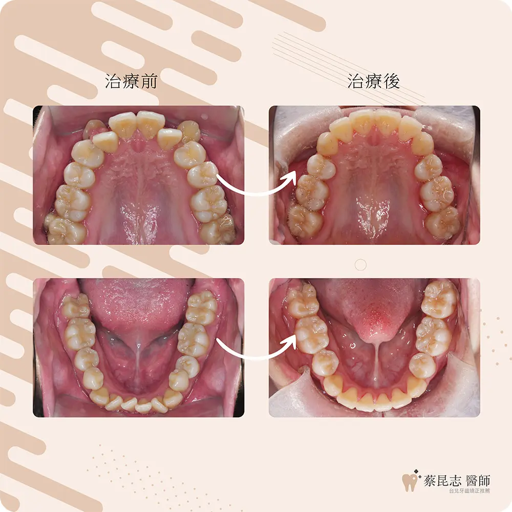 【牙齒矯正】前牙嚴重擁擠+上顎虎牙 4 cases demo 1