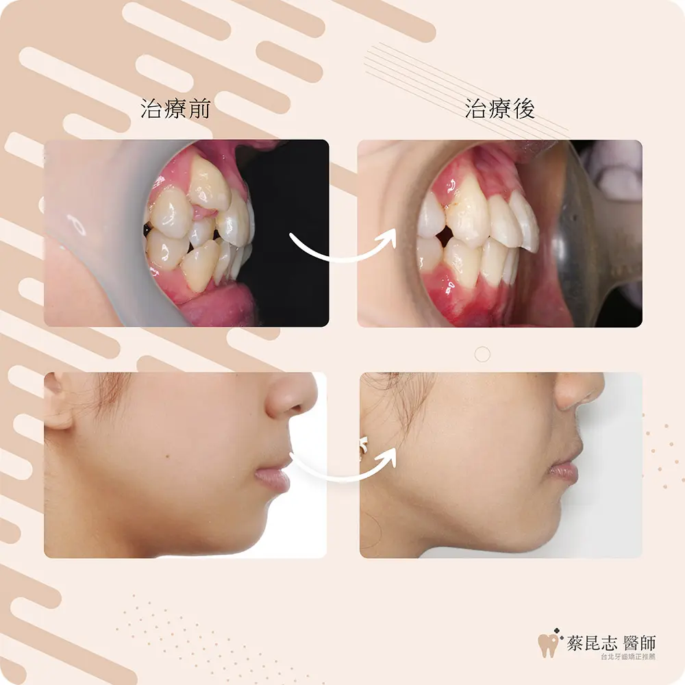 【牙齒矯正】前牙嚴重擁擠+上顎虎牙 6 cases demo 6