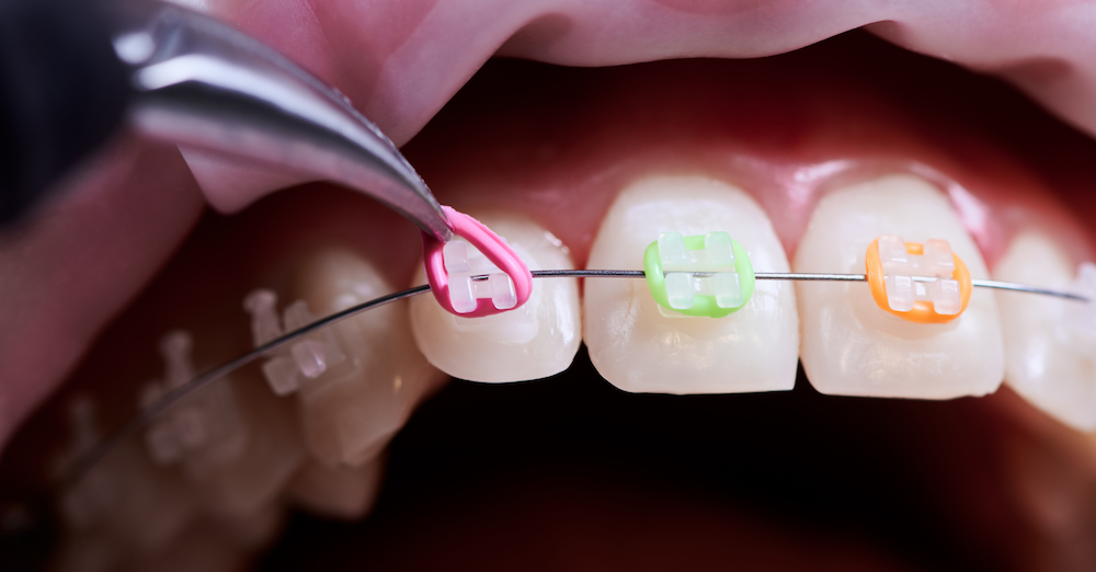 dentist removing rubber bands from patient braces 2022 05 28 10 47 41 utc 1
