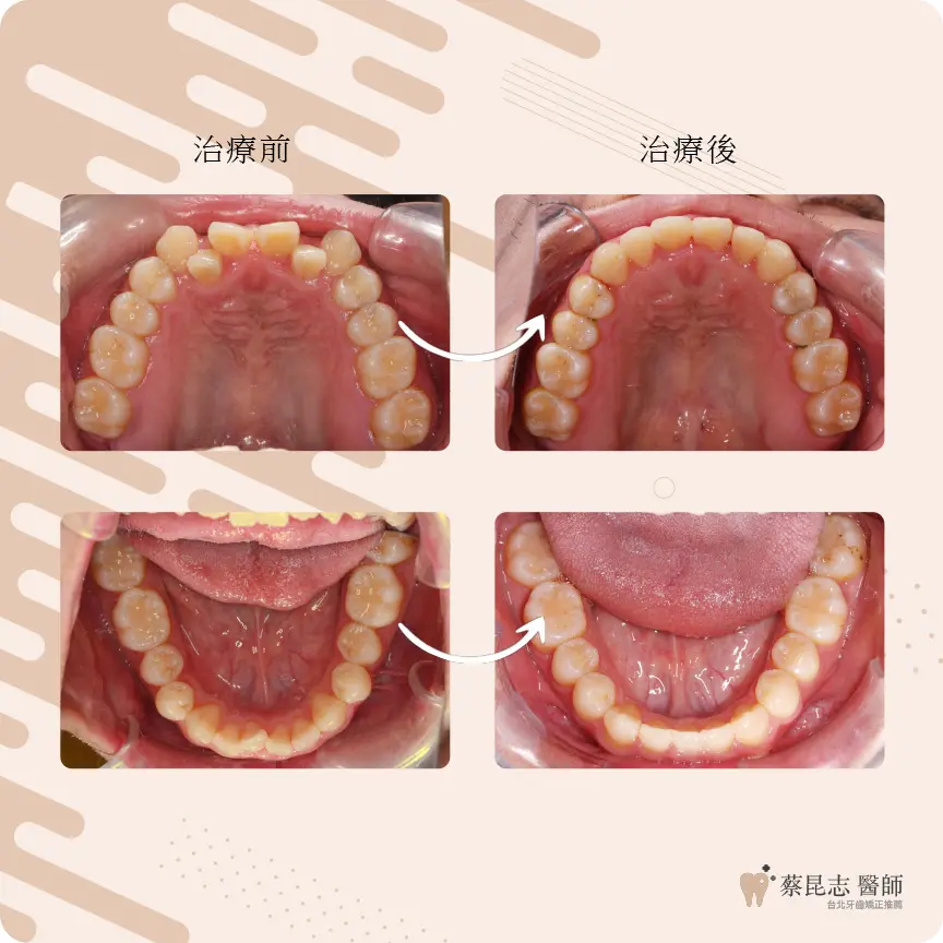 【牙齒矯正】前牙錯咬戽斗 4 cases demo 2 1