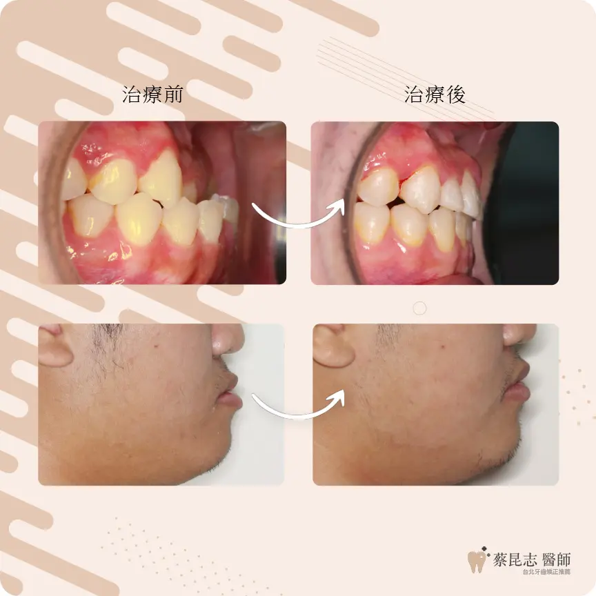 【牙齒矯正】前牙錯咬戽斗 6 cases demo 2 6