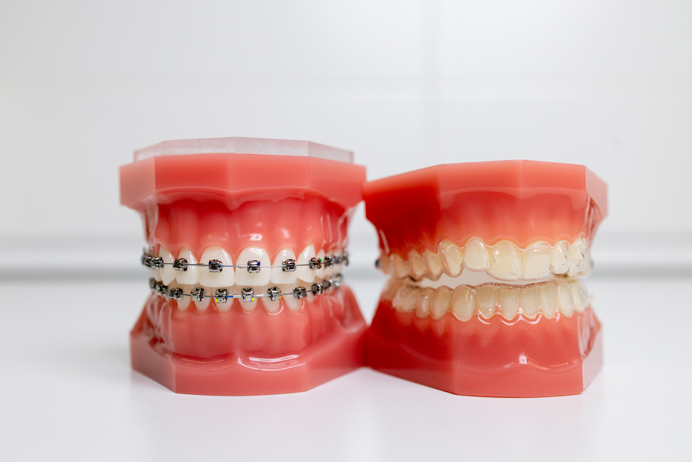 mouth guard and models of teeth with braces on tee 2022 10 18 00 02 46 utc 1