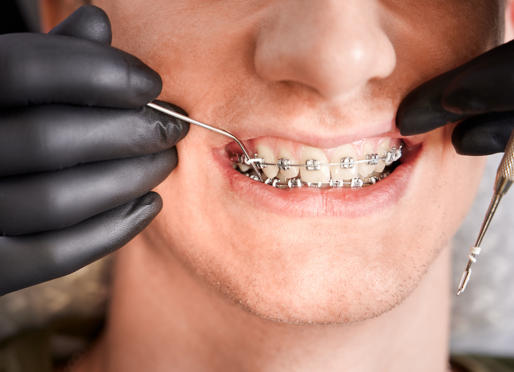 orthodontist placing rubber bands on male patient 2022 05 30 22 51 21 utc 1