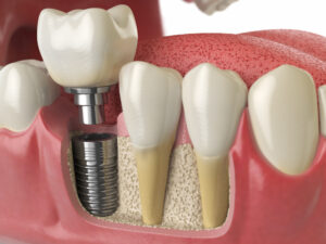 anatomy of healthy teeth and tooth dental implant 2021 08 26 16 56 57 utc 1