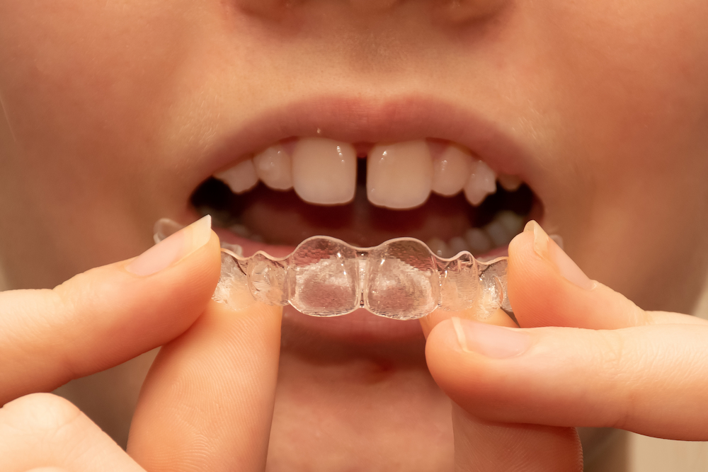 girl put on invisalign invisible braces bonded at 2022 11 15 14 04 50 utc 1