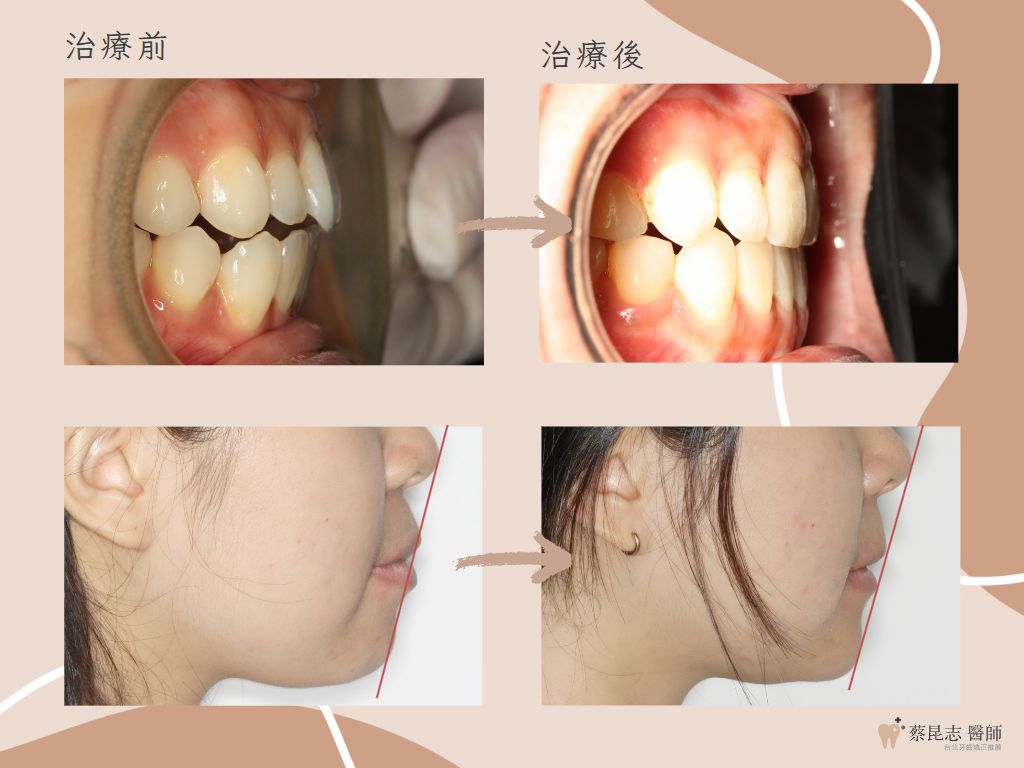 orthodontics case3 10