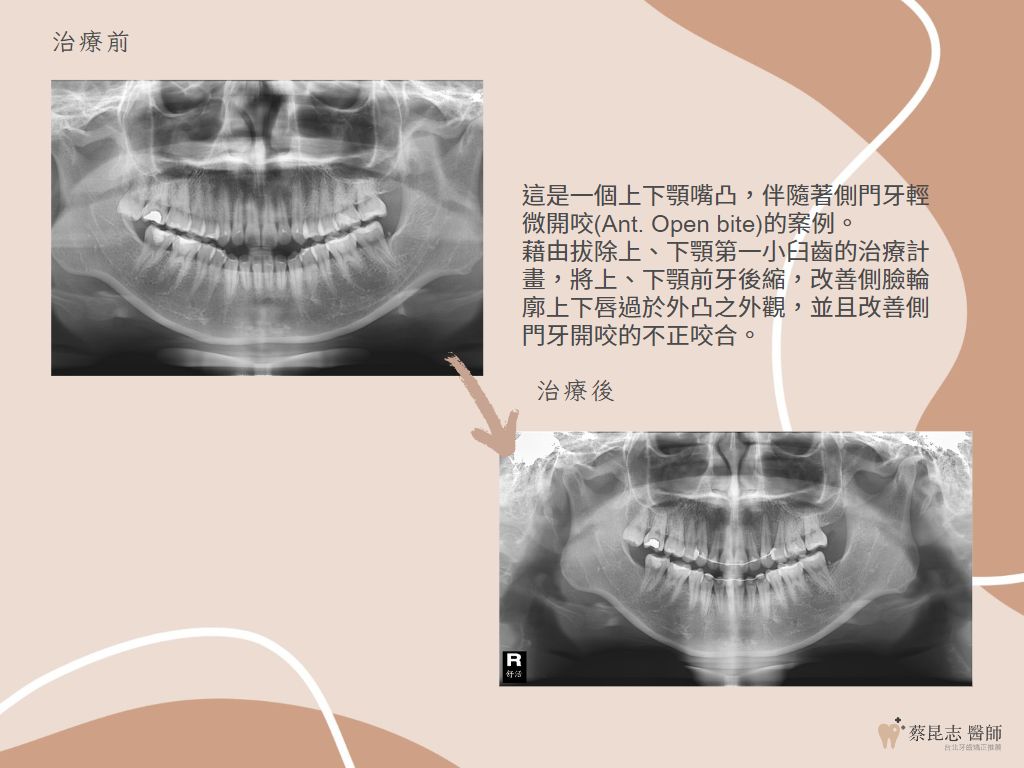 orthodontics case3 2