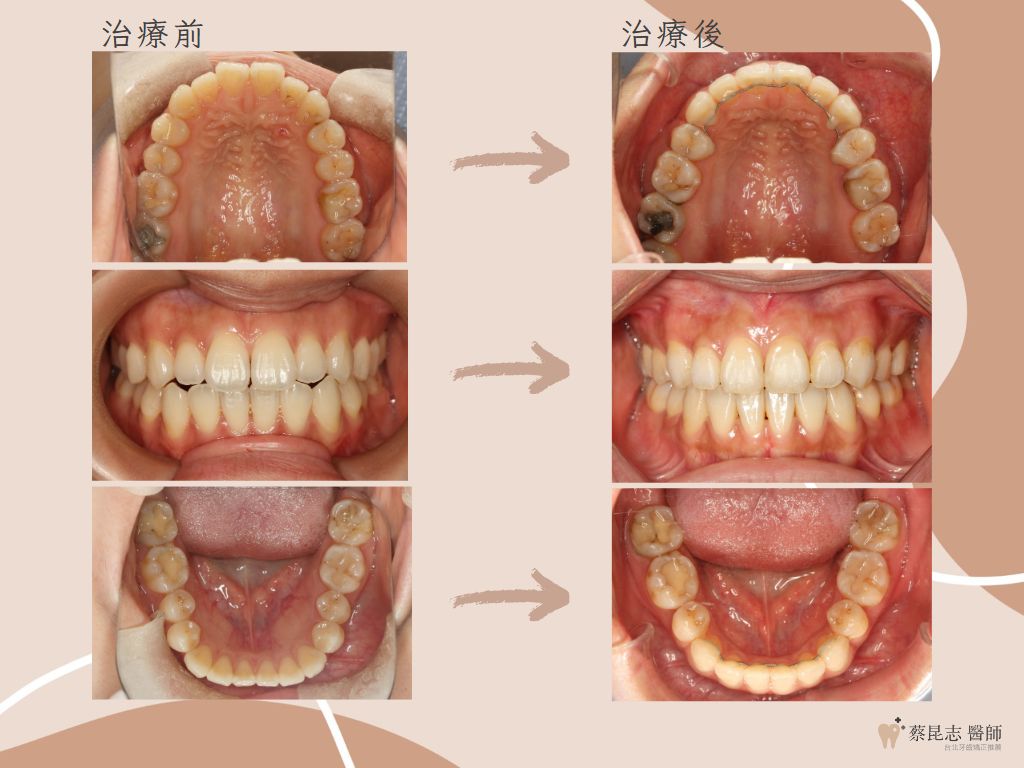 orthodontics case3 4