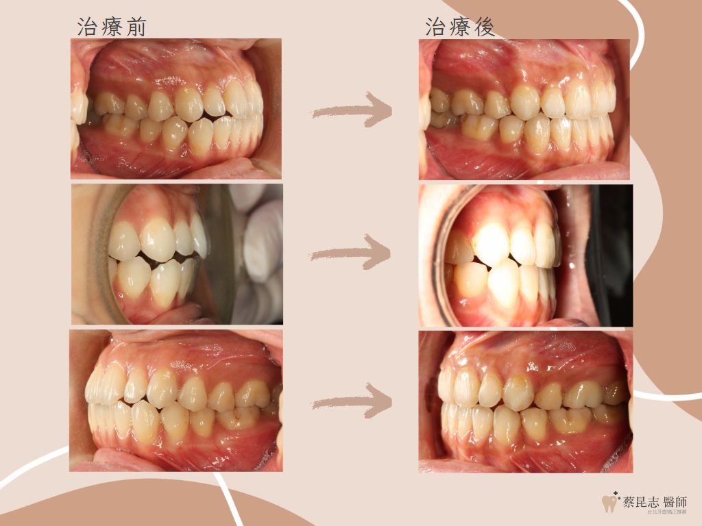 orthodontics case3 5