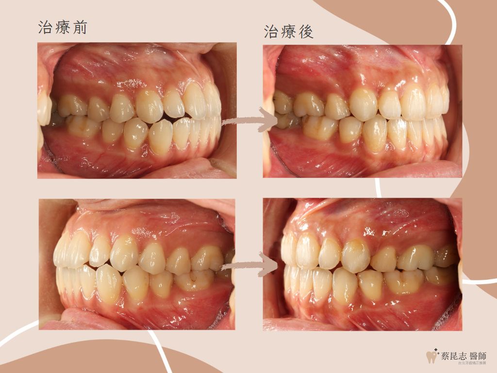 orthodontics case3 6