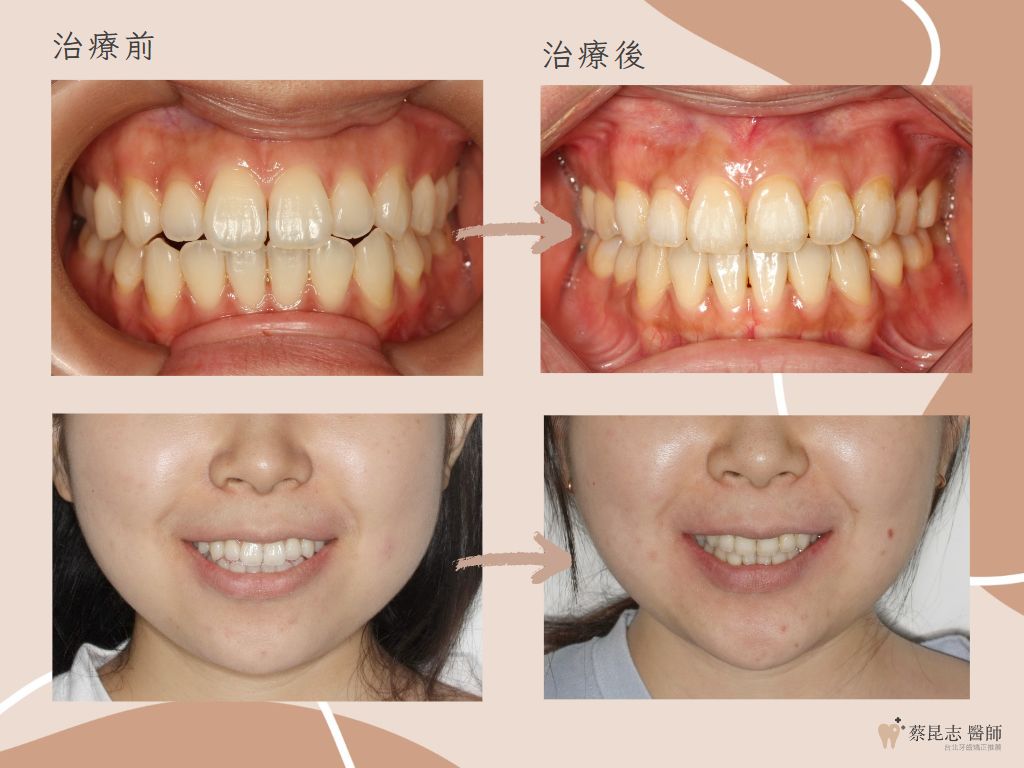 orthodontics case3 8