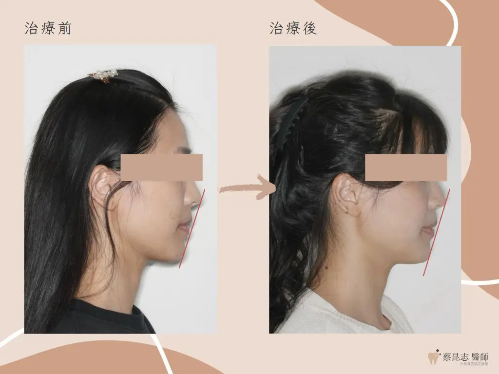 【牙齒矯正】前牙開咬不拔牙矯正治療 11 orthodontics case4 1