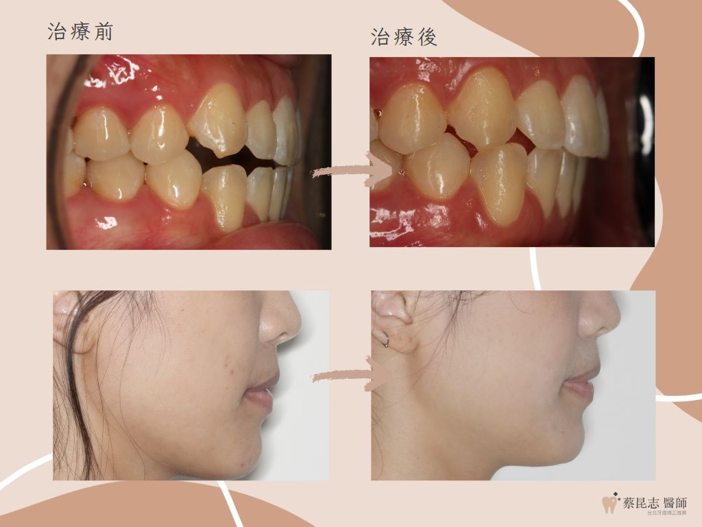 orthodontics case4 10