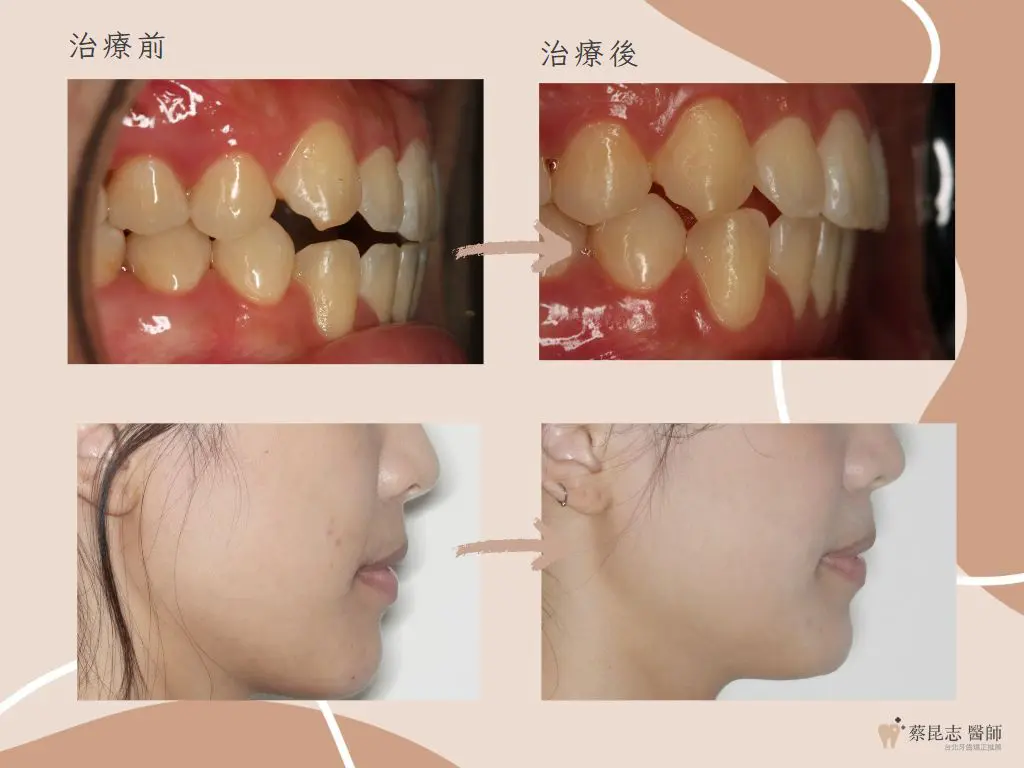 【牙齒矯正】前牙開咬不拔牙矯正治療 8 orthodontics case4 10