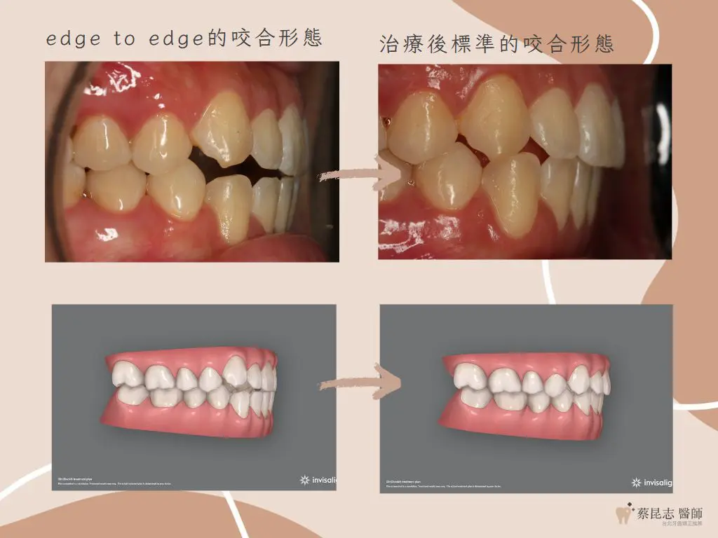 【牙齒矯正】前牙開咬不拔牙矯正治療 9 orthodontics case4 11