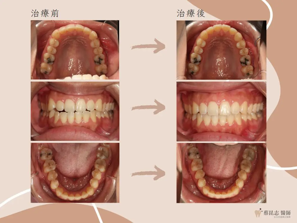 【牙齒矯正】前牙開咬不拔牙矯正治療 2 orthodontics case4 3