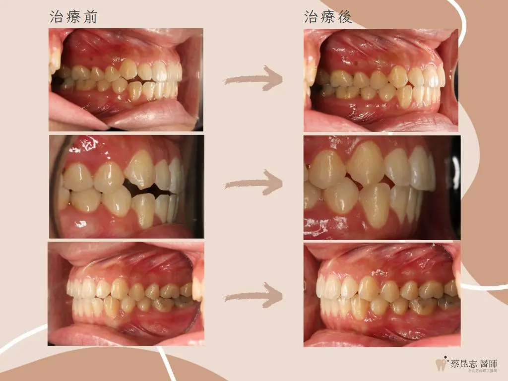 【牙齒矯正】前牙開咬不拔牙矯正治療 3 orthodontics case4 4
