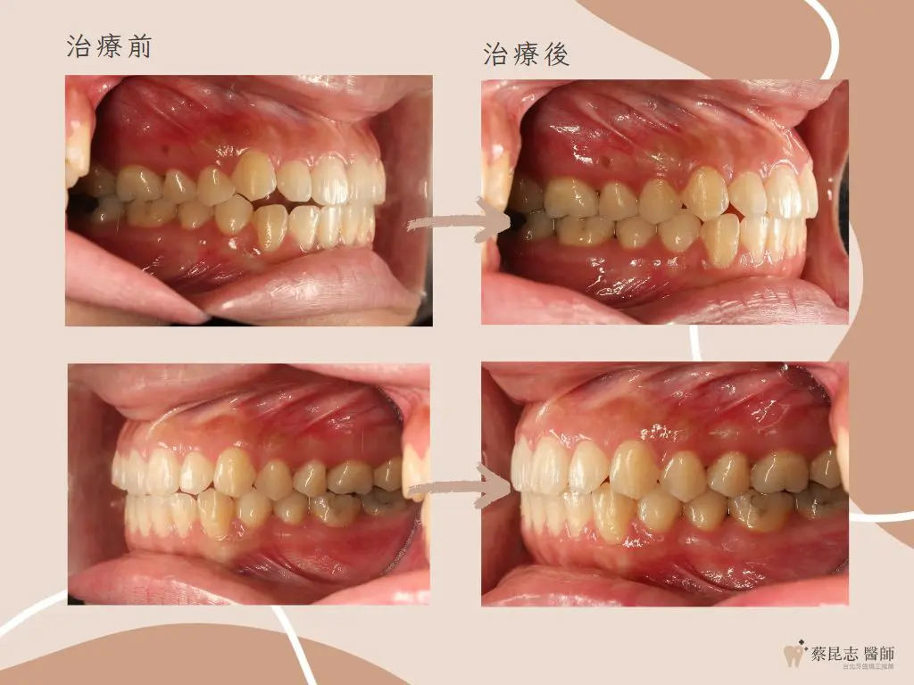 【牙齒矯正】前牙開咬不拔牙矯正治療 4 orthodontics case4 5