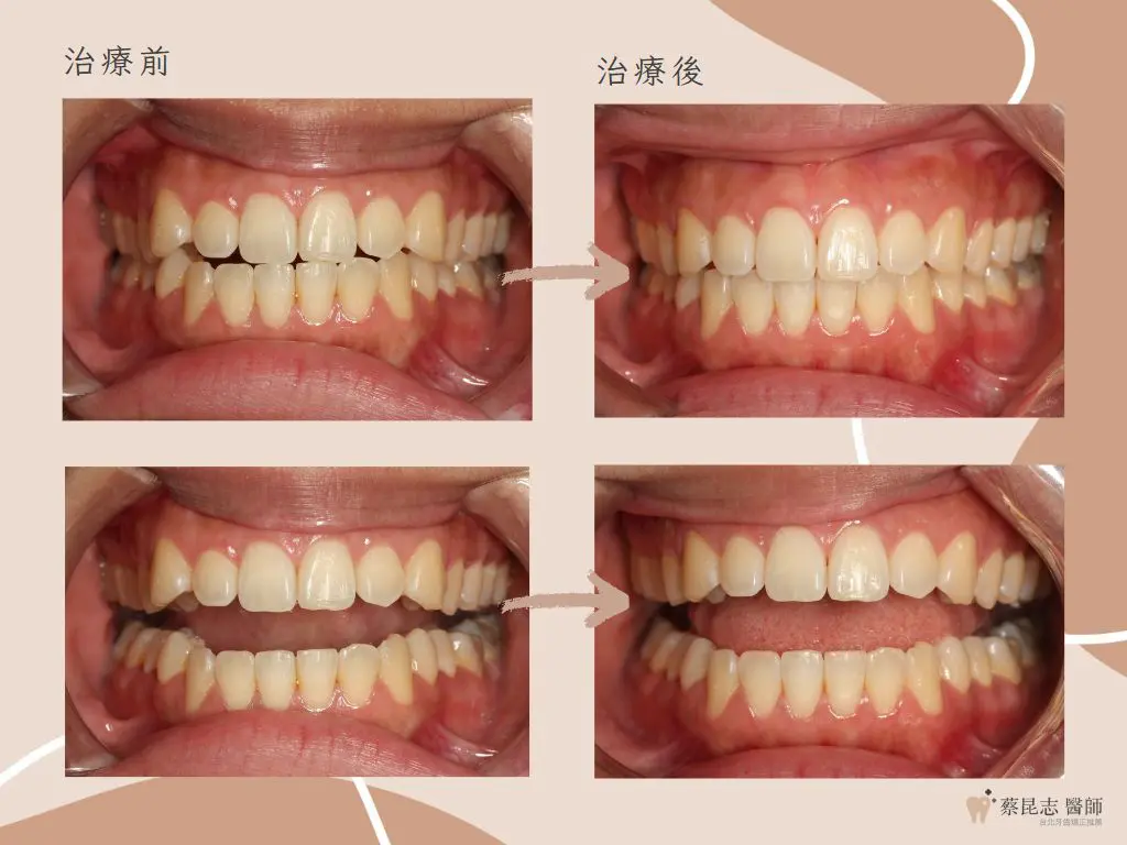 【牙齒矯正】前牙開咬不拔牙矯正治療 5 orthodontics case4 6