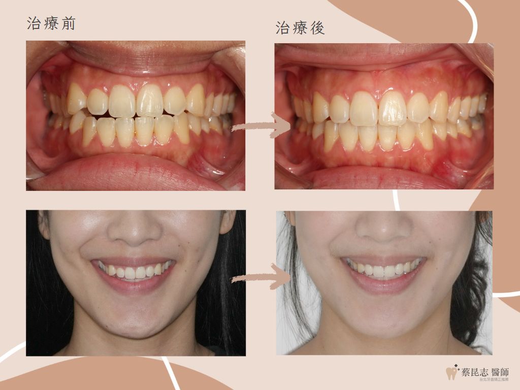 orthodontics case4 8