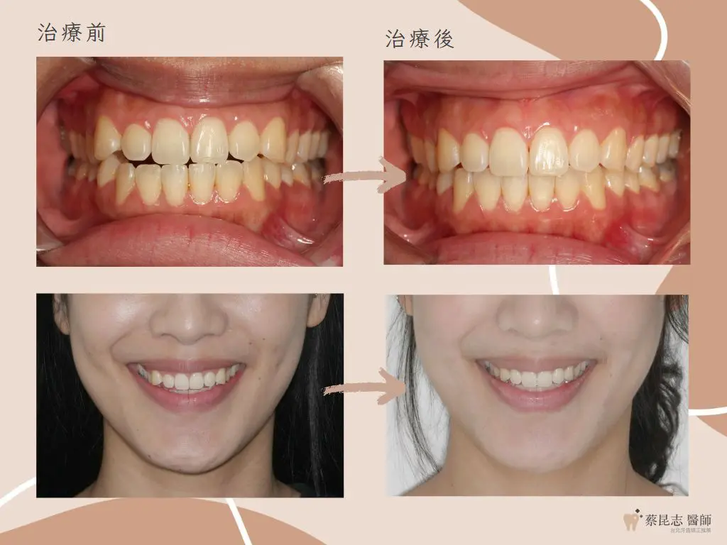 【牙齒矯正】前牙開咬不拔牙矯正治療 6 orthodontics case4 8