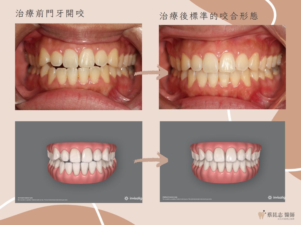 orthodontics case4 9