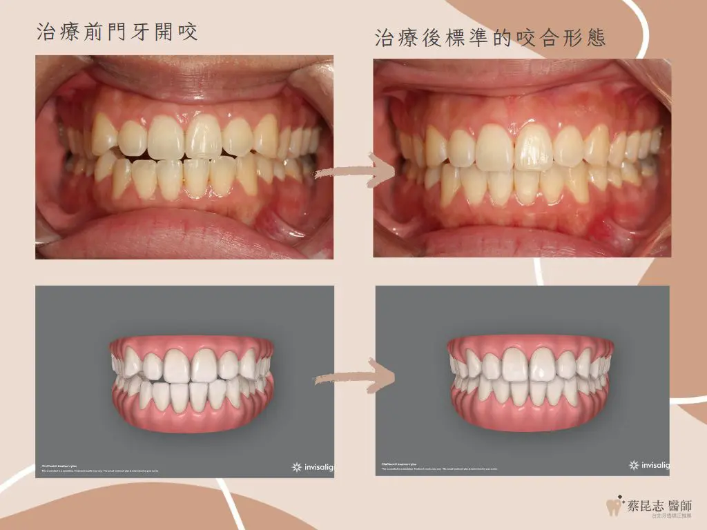 【牙齒矯正】前牙開咬不拔牙矯正治療 7 orthodontics case4 9