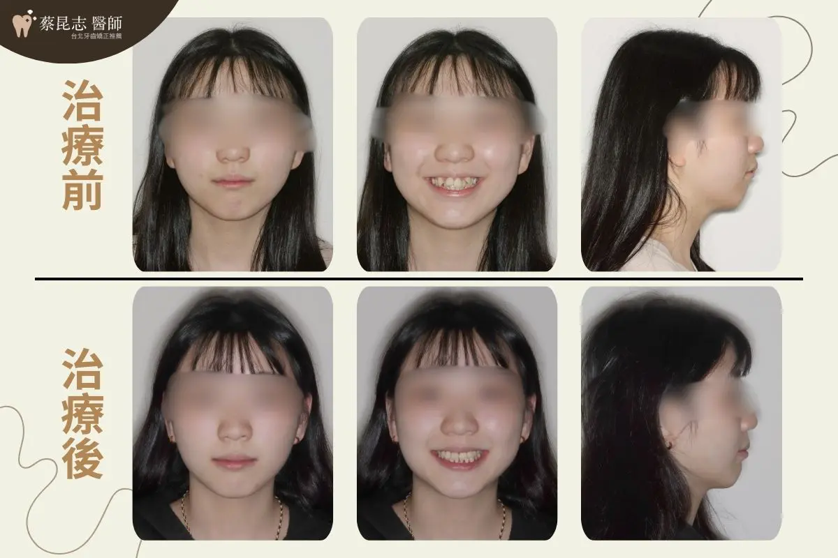 【牙齒矯正】牙齒亂,暴牙拔牙矯正 1 暴牙拔牙矯正臉型變化