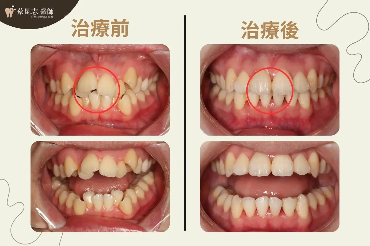 【牙齒矯正】牙齒亂,暴牙拔牙矯正 4 暴牙拔牙矯正前後門牙變化對比