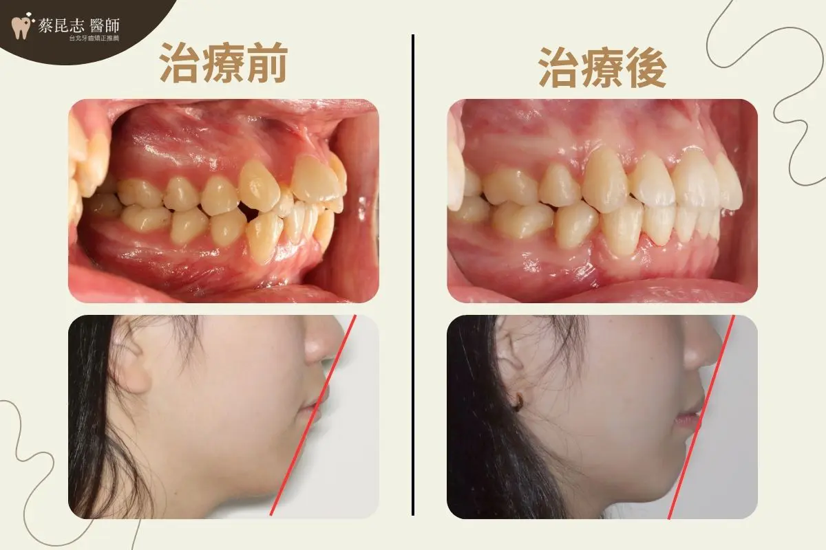 【牙齒矯正】牙齒亂,暴牙拔牙矯正 5 暴牙拔牙矯正前後嘴型變化