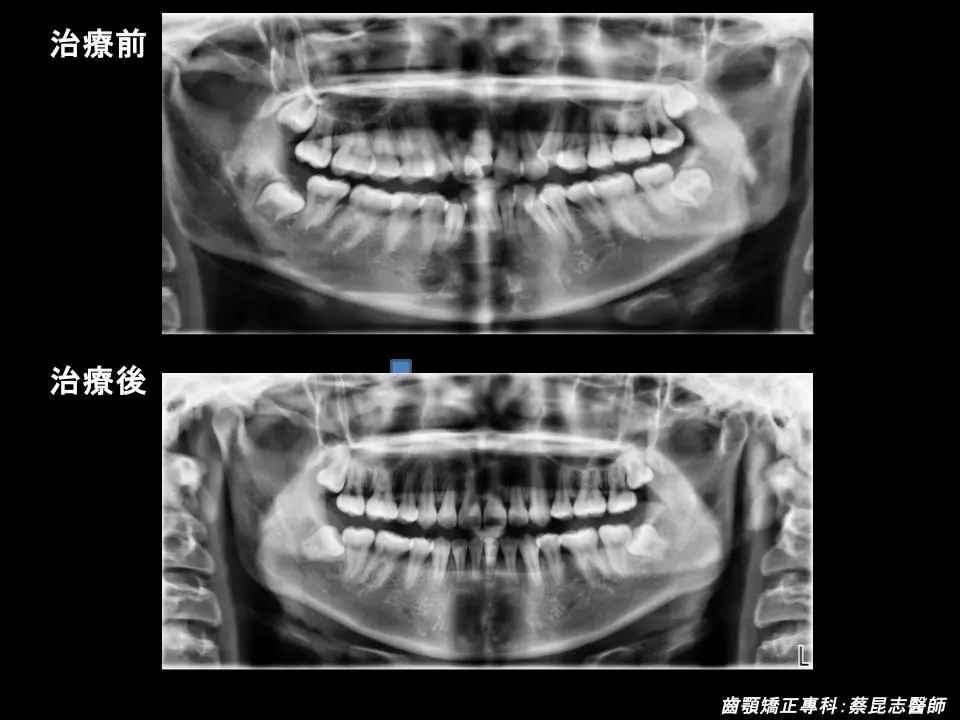 【牙齒矯正】牙齒亂,暴牙拔牙矯正 6 暴牙拔牙矯正前後x光變化