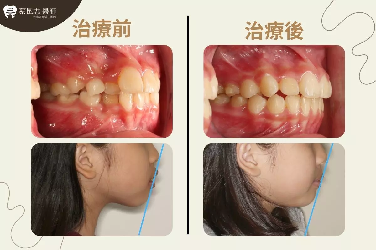 【牙齒矯正】兒童隱適美矯正 5 5