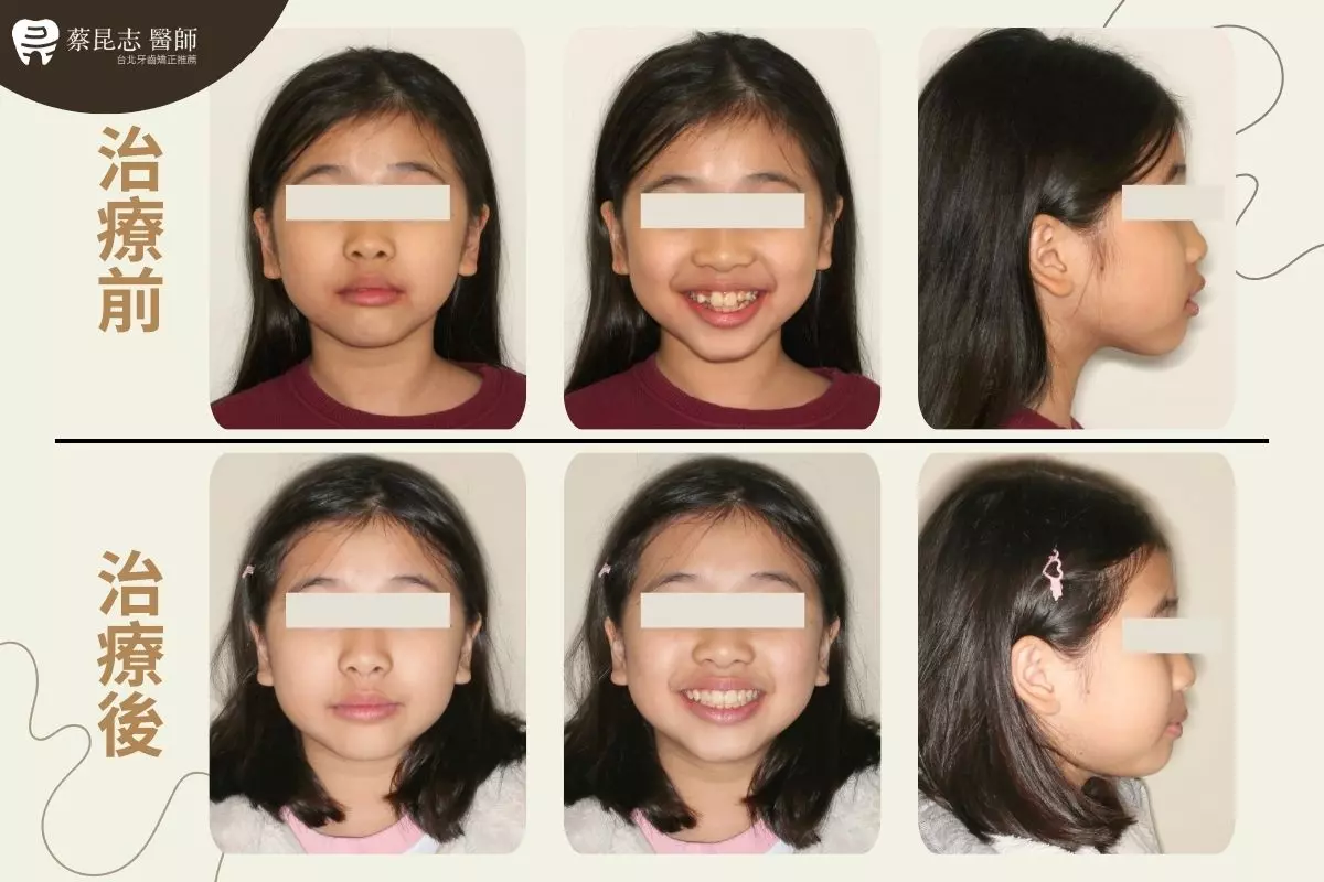 httpswww.drkun .twinvisalign for kids orthodontics