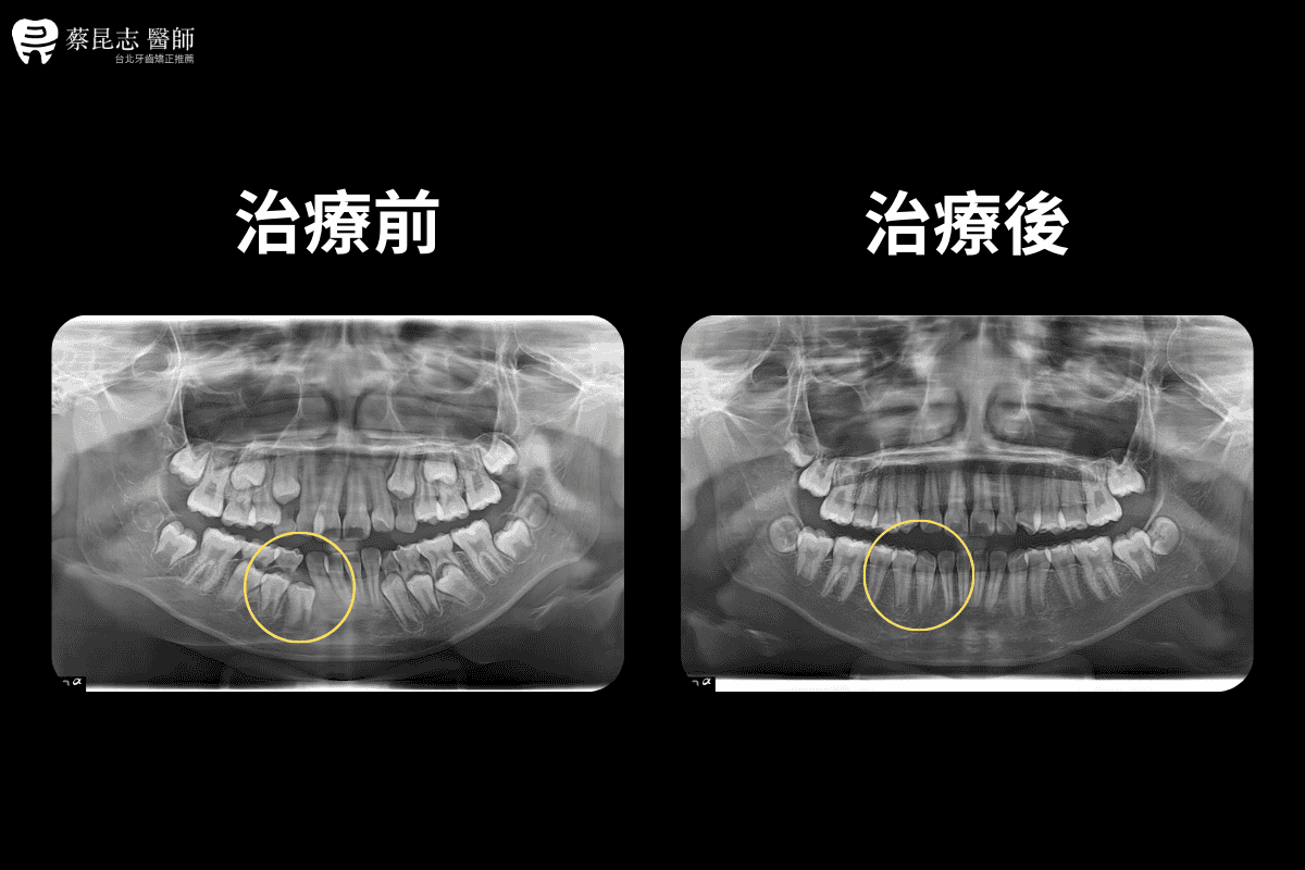 【牙齒矯正】兒童隱適美矯正 6 no.5兒童隱適美 6
