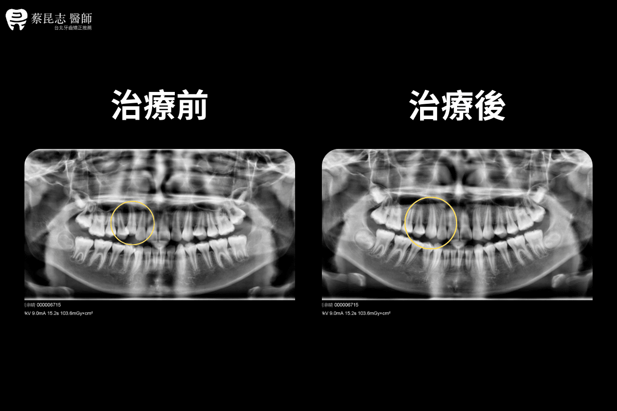 【牙齒矯正】上顎高位犬齒早期矯正未拔牙 6 no.6小六學生右上高位犬齒虎牙 6 1