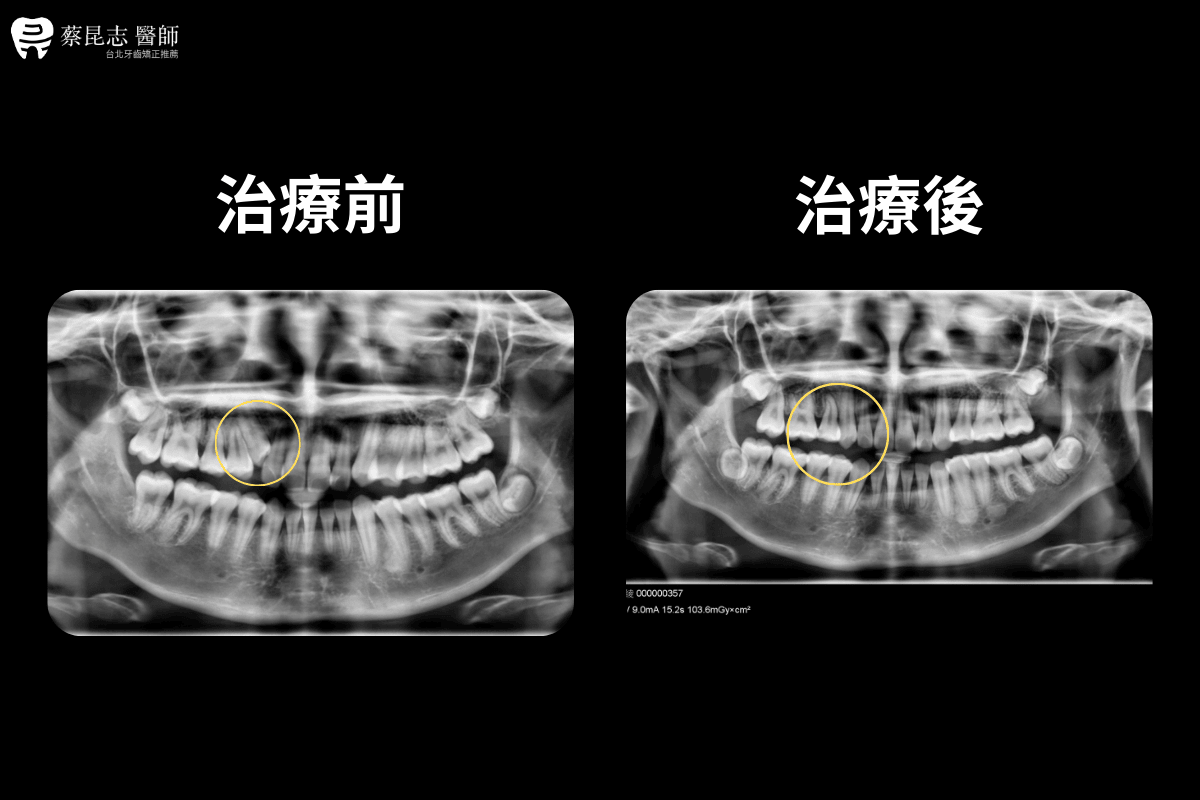 【牙齒矯正】上顎高位犬齒矯正拔牙治療 6 no.7 高中生右上高位犬齒虎牙 6 1
