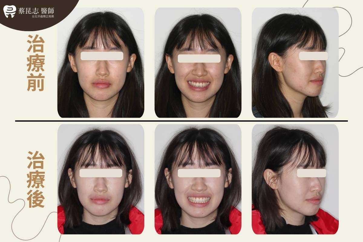 【牙齒矯正】下嘴唇外凸戽斗 1 protruding lips and underbite 1
