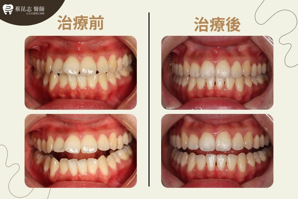 【牙齒矯正】下嘴唇外凸戽斗 4 protruding lips and underbite 4