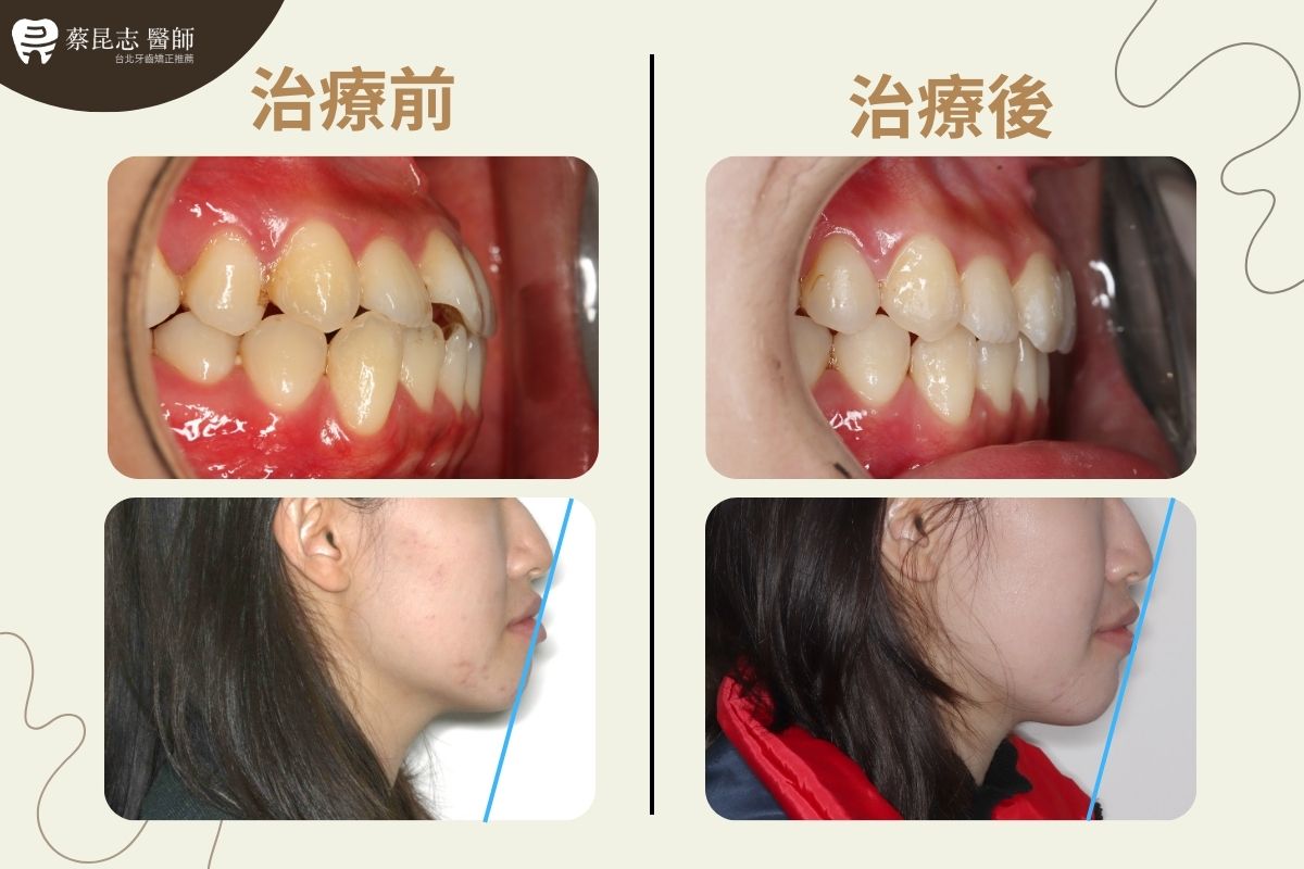 【牙齒矯正】下嘴唇外凸戽斗 5 protruding lips and underbite 5