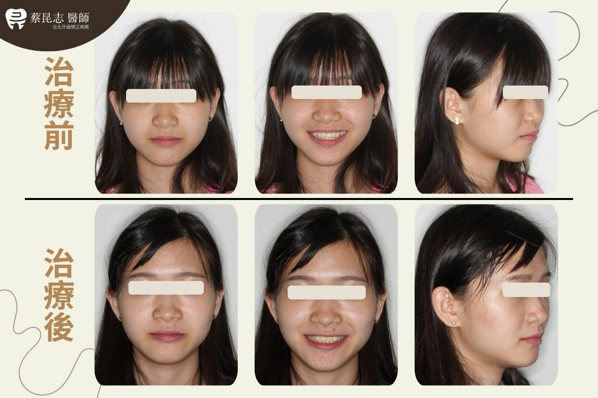 【牙齒矯正】上下顎齒列擁擠拔四顆小臼齒 1 upper and lower dental crowding 1
