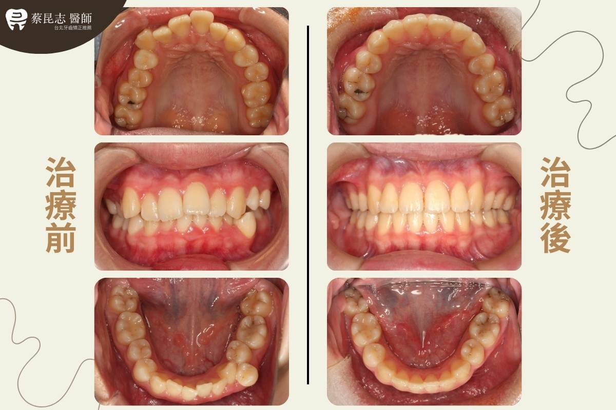 【牙齒矯正】上下顎齒列擁擠拔四顆小臼齒 2 upper and lower dental crowding 2