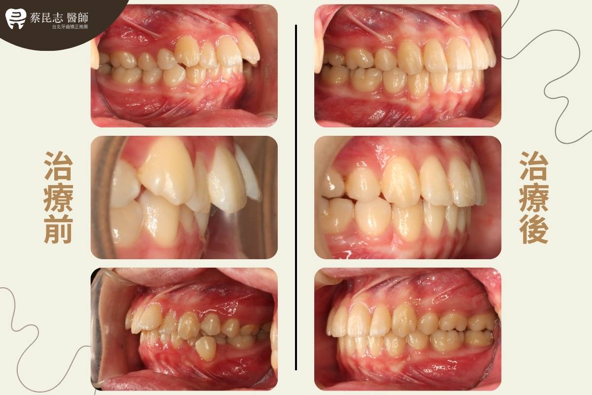 【牙齒矯正】上下顎齒列擁擠拔四顆小臼齒 3 upper and lower dental crowding 3