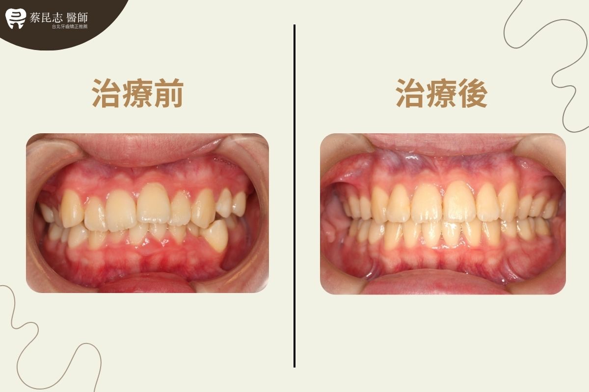 【牙齒矯正】上下顎齒列擁擠拔四顆小臼齒 4 upper and lower dental crowding 4