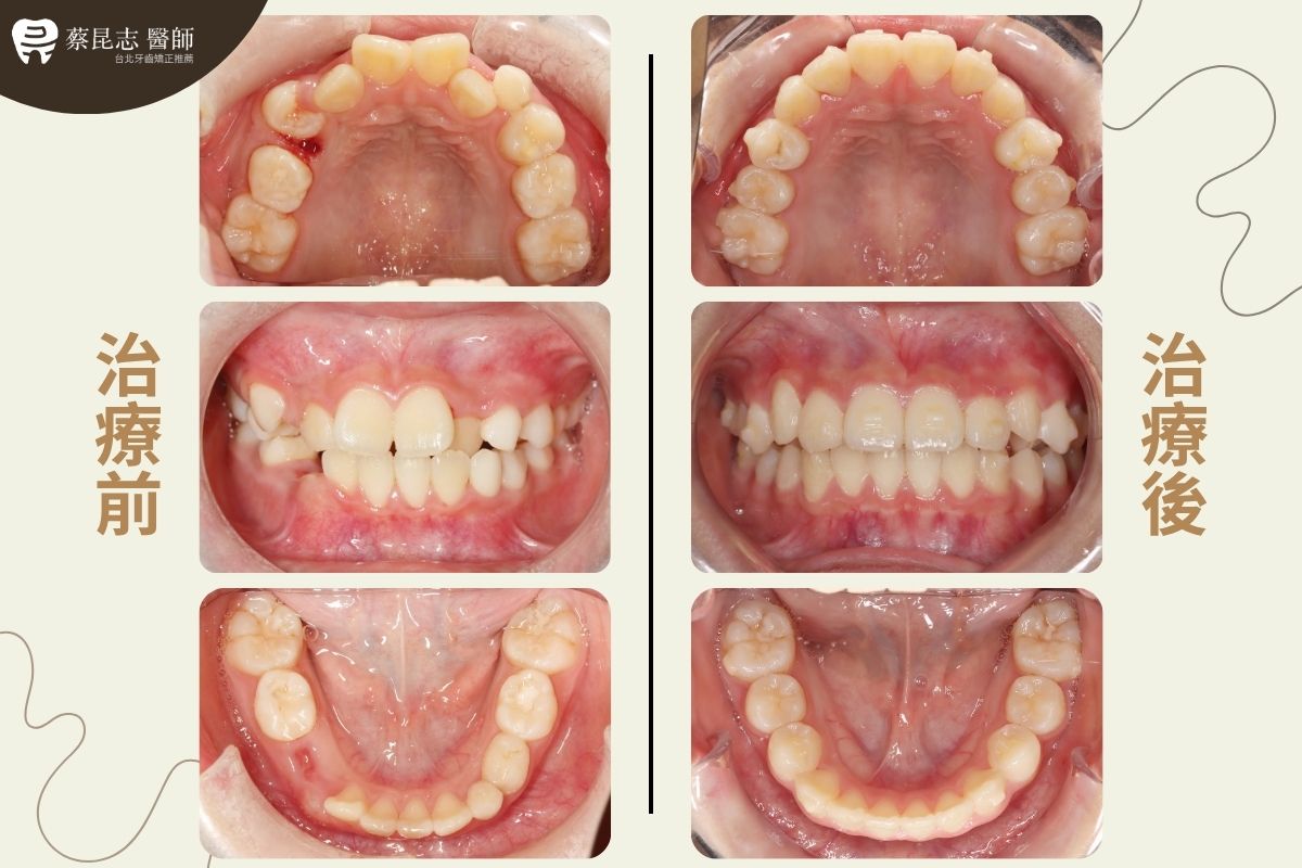 【牙齒矯正】兒童矯正恆齒空間不足 2 Insufficient Space for Permanent Teeth 2