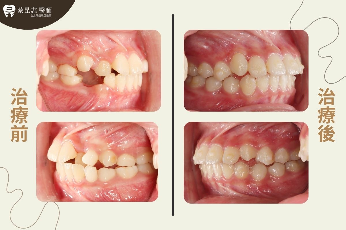 【牙齒矯正】兒童矯正恆齒空間不足 3 Insufficient Space for Permanent Teeth 3 1