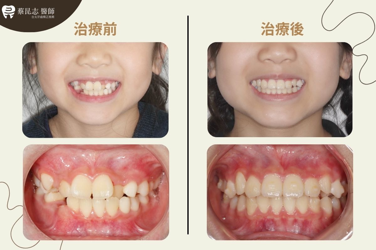 【牙齒矯正】兒童矯正恆齒空間不足 4 Insufficient Space for Permanent Teeth 4