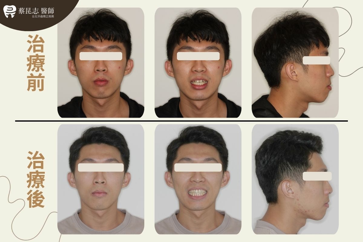 【牙齒矯正】下嘴唇外凸齒列擁擠不對稱拔牙 1 asymmetric tooth extraction 1 1 1