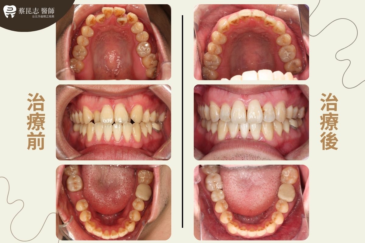 【牙齒矯正】下嘴唇外凸齒列擁擠不對稱拔牙 2 asymmetric tooth extraction 2 1